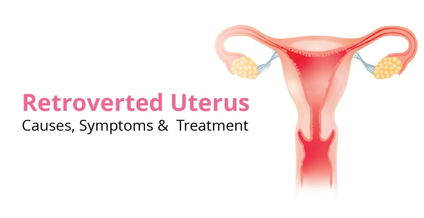 Retroverted Uterus: Causes, Symptoms & Treatment