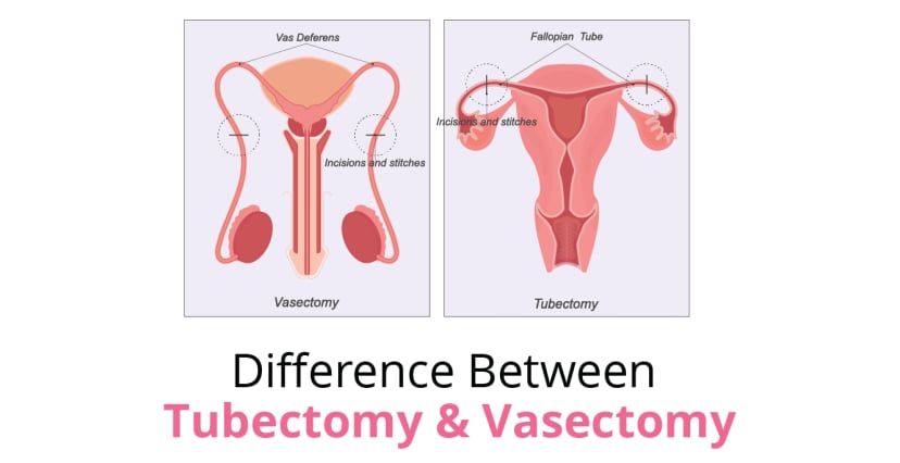 Difference Between Tubectomy and Vasectomy